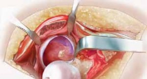 Illustration 20 for FAI: Impingement and Surgical Dislocation Explained