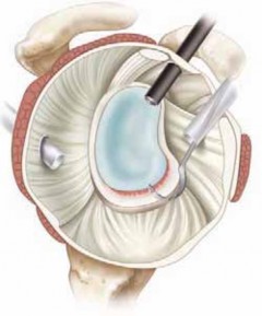 Illustration 21 for Regain Stability: Anterior Shoulder Instability Arthroscopic Fix