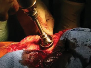 Illustration 10 for Solving Severe Bone Loss: Tantalum for Patellar Reconstruction