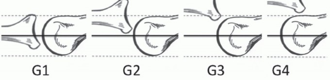 Illustration 5 for Plantar Plate Repair: End Lesser Toe Pain & Instability