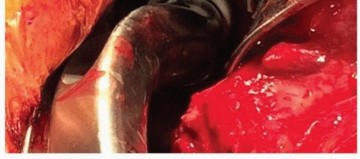 Illustration 9 for Mastering The Uncemented Socket: Ensure Lasting Hip Fixation