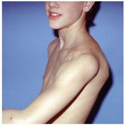 Finally Treat Recurrent Posterior Instability of the Shoulder