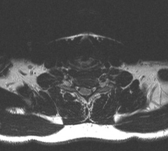 Illustration 14 for Spine Cases: Consider the Patient for Accurate Diagnosis