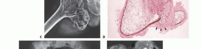 Illustration 45 for Understanding Benign Bone Tumors: Your Complete Preoperative Guide