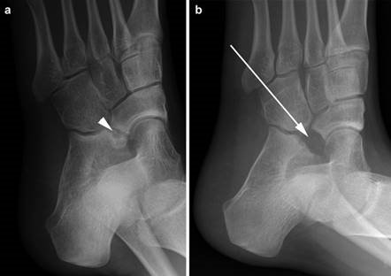 Illustration 51 for First Metatarsal Surgery: Expert Solutions for Foot & Ankle Pain