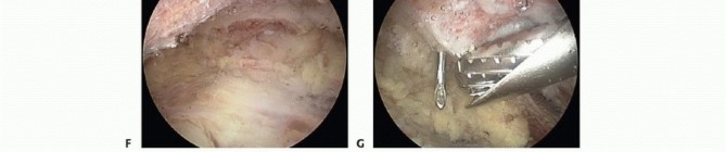 Illustration 10 for Find Relief: Arthroscopic Subacromial Decompression for Impingement