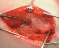 Illustration 12 for Increased Femoral Anteversion: A Proximal Femoral Rotational Osteotomy