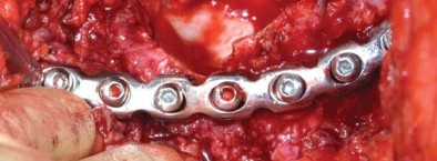 Illustration 50 for Management of Periprosthetic Fractures: An Expert Surgical Guide