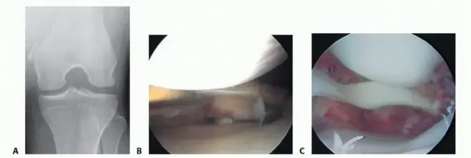 إصابة الرباط الجانبي الإنسي (MCL) في الركبة: دليل المريض الشامل للتعافي