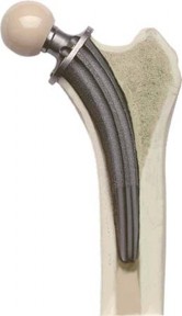 Illustration 4 for Collum Femoris Preserving: Achieve Better Primary Hip Outcomes