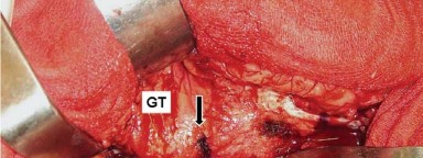 صورة توضيحية لـ إتقان توازن الأنسجة الرخوة لمفصل ورك صناعي مثالي: دليل شامل للمرضى مع الأستاذ الدكتور محمد هطيف