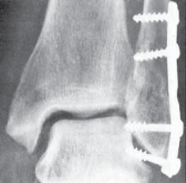 Illustration 22 for Optimal Fixation of the Ankle: Open Reduction & Internal Fixation
