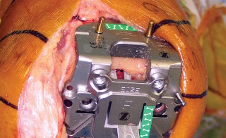 صورة طبية: استبدال مفصل الركبة بالحد الأدنى من التدخل الجراحي: ألم أقل وتعافٍ أسرع مع النهج شبه الرضفي الإنسي