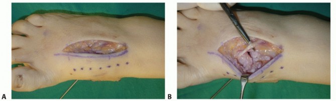 Illustration 45 for Mastering Midfoot Arthrodesis: Protect the Deep Neurovascular Bundle