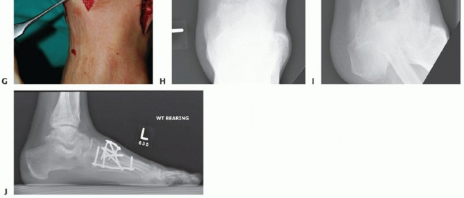 Illustration 75 for Mastering Midfoot Arthrodesis: Protect the Deep Neurovascular Bundle