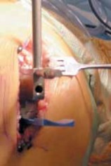 Illustration 17 for Knee Arthroplasty Unicondylar: Discover if Partial Knee Replacement is Right