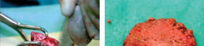 Illustration 37 for Optimizing Acetabular Component Cementation for Superior Outcomes