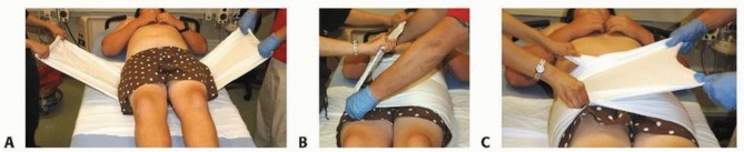Illustration 12 for Emergency Fixation of the Pelvis: Control Bleeding & Restore Stability