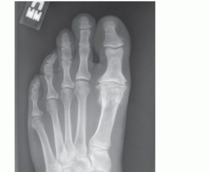 Relieve Hallux Rigidus Pain with Capsular Interpositional Arthroplasty