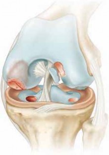 Diduch Dr Hampton on OCD & Avascular Necrosis: What You Need to Know