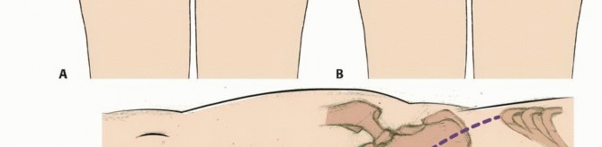 Illustration 24 for Sacral Tumor Surgery: Safeguarding Bowel & Bladder Control