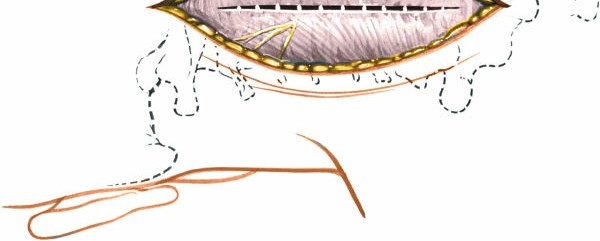 Illustration 172 for Approach to the Lumbar Spine: Mastering Techniques & Anatomy