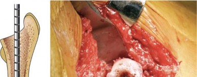 Illustration 17 for Mastering Cementing Technique Femur: A Step-by-Step Guide