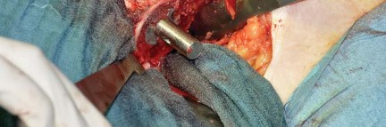 Illustration 53 for Collum Femoris Preserving: Achieve Better Primary Hip Outcomes