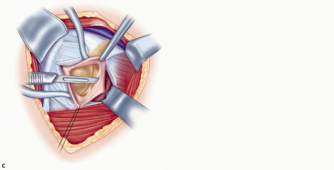 Illustration 24 for Bankart Repair & Inferior Capsular Shift: Solving Shoulder Instability