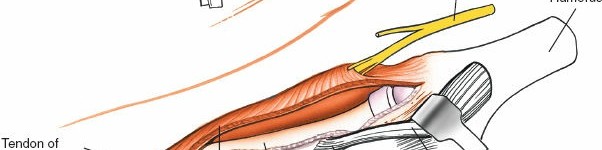 Illustration 66 for Mastering Elbow Approaches: Applied Surgical Anatomy for Precision