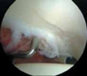 Illustration 21 for Solving Hip Soft Tissue Pathology with Advanced Arthroscopy