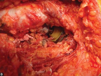 Illustration 67 for The Silent Hip: Achieving a Truly Silent, Pain-Free Joint