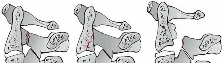 كسور الفقرة العنقية الثانية (C2): الدليل الشامل للمرضى مع الأستاذ الدكتور محمد هطيف