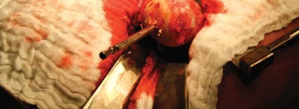 Illustration 56 for Metal on Metal Resurfacing: Enhanced Posterior Soft Tissue Repair