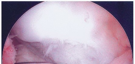 Illustration 20 for Dissecans of the Knee: What's the Difference – OCD vs. AVN?