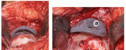 Uncemented Acetabular Component: Augments & Cup-Cages for Bone Loss