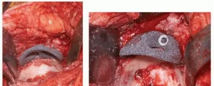 صورة توضيحية لـ جراحة مراجعة الحُق غير المُثبّت: حلول متقدمة لفقدان عظم الورك الشديد بالدعامات والقفص الكوبي