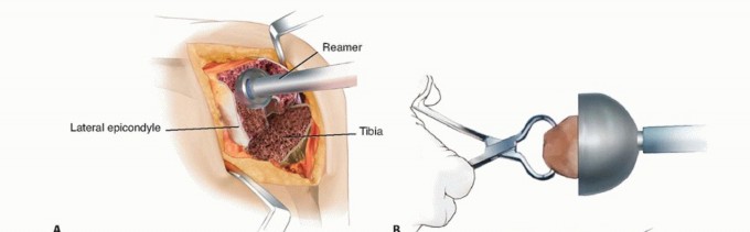 Illustration 12 for Femoral Bone Loss: Metal Augments for Revision Knee Success