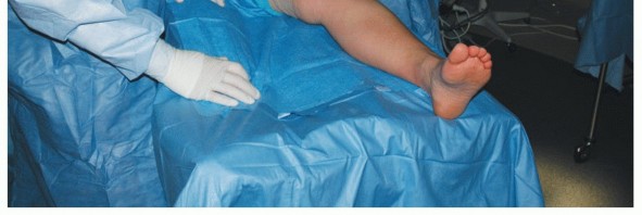 Illustration 5 for Painful Talus Lesions? The tech fig c Osteochondral Transfer Solution