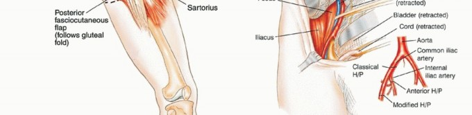Illustration 11 for Posterior Flap Hemipelvectomy: Mastering Techniques for Optimal Outcomes