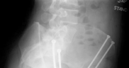 Illustration 8 for Periacetabular Osteotomy: End Hip Pain, Improve Flexion and Internal Motion