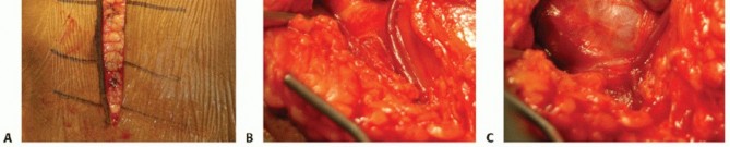 Illustration 17 for Optimizing Fixation of Proximal Humerus Fractures: A Guide