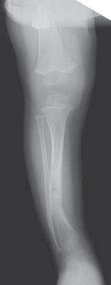 Illustration 6 for Solving Congenital Pseudarthrosis: Tibia with the Williams Rod