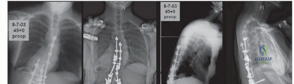 صورة توضيحية لـ جراحة طرح الفقرة وتصحيح الحداب: دليل شامل للمرضى مع الأستاذ الدكتور محمد هطيف