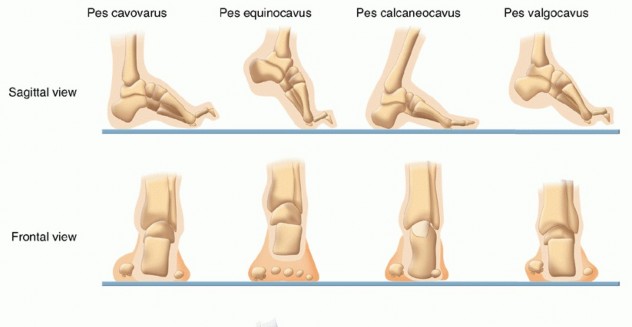 How Achilles Tendon Lengthening Fixes Equinocavovarus Foot