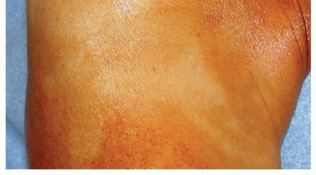 Illustration 8 for Subscapularis & Teres Rotator Cuff Repair: Advanced Techniques