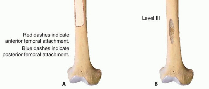 Illustration 2 for Overcoming Proximal Femoral Bone Loss: Fluted Stems in Revision THA
