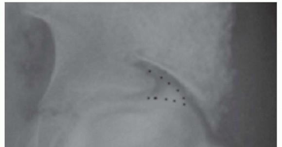 Labral Support Shelf Procedure: Preventing Perthes Deformity