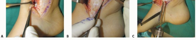 Illustration 2 for Unlock Healing: Medial Malleolar Osteotomy for Talus OLT Allografts