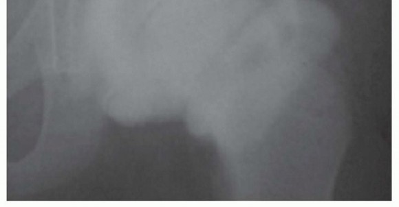 Illustration 2 for Labral Support Shelf Procedure: Preventing Perthes Deformity